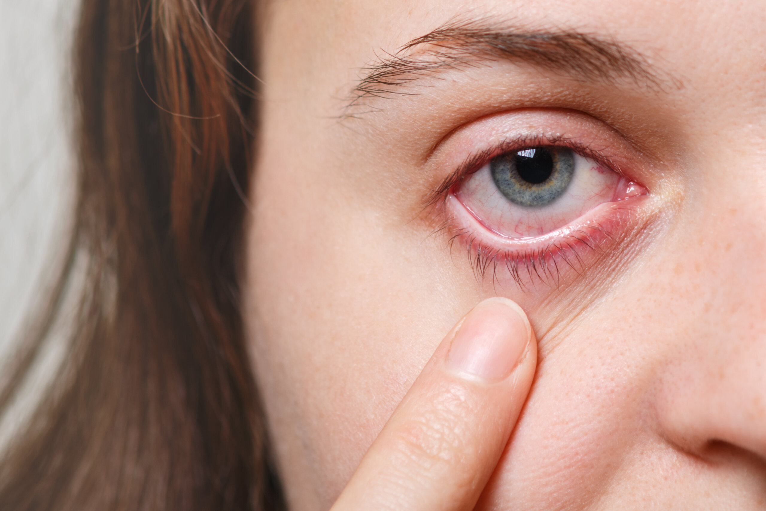 Conjunctivitis: A Comprehensive Guide