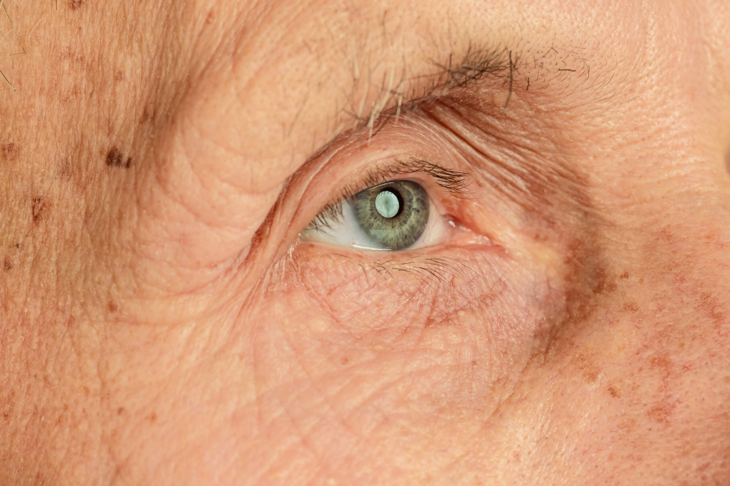 Cataracts: An In-depth Analysis