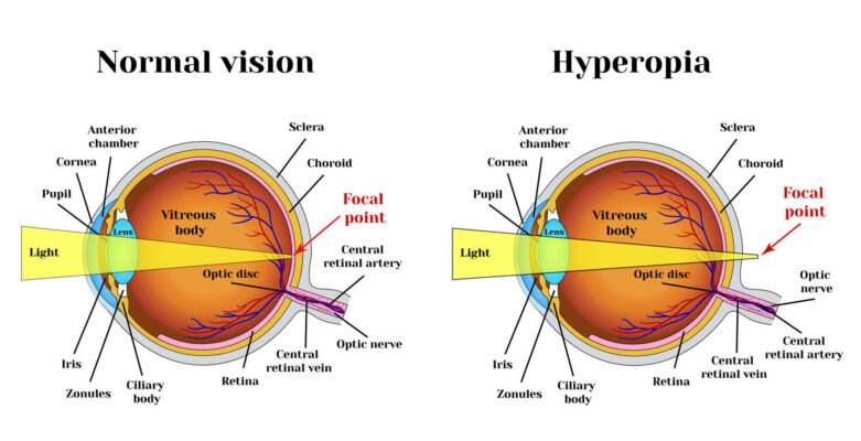 normal vision vs farsighted