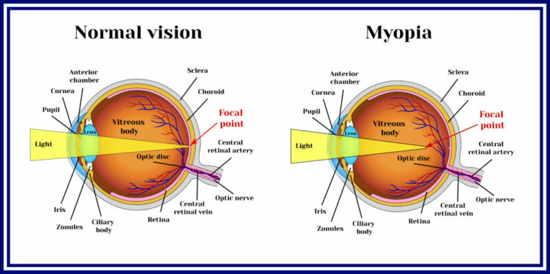 normal vision vs nearsighted